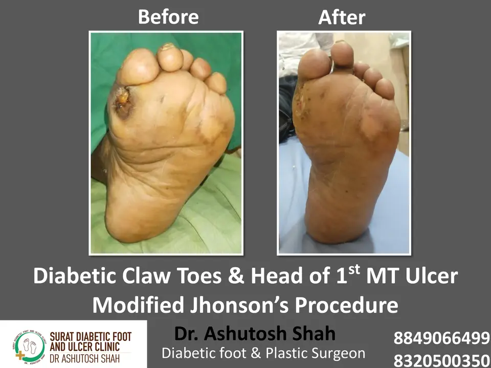 Diabetic Foot  PPT sunita.pptx-26.webp